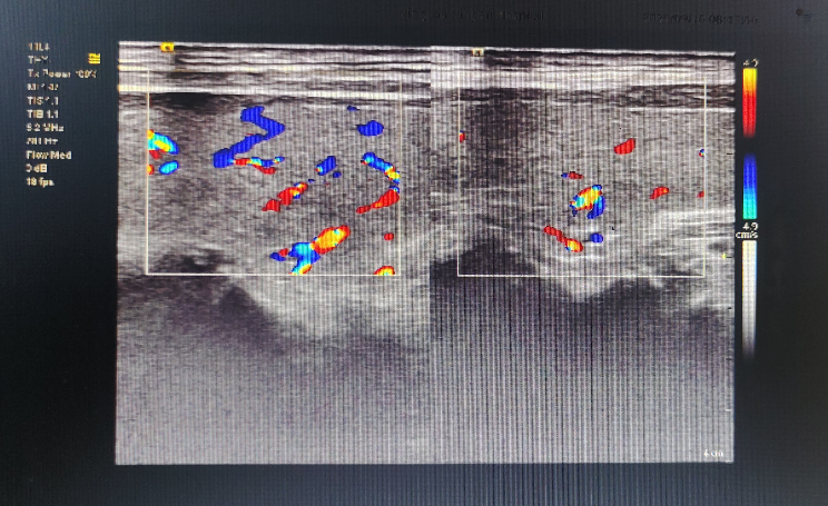 精神心理疾病患者为何要查甲状腺彩超？——一篇看懂关键联系